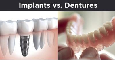 dentures-vs-dental-implants