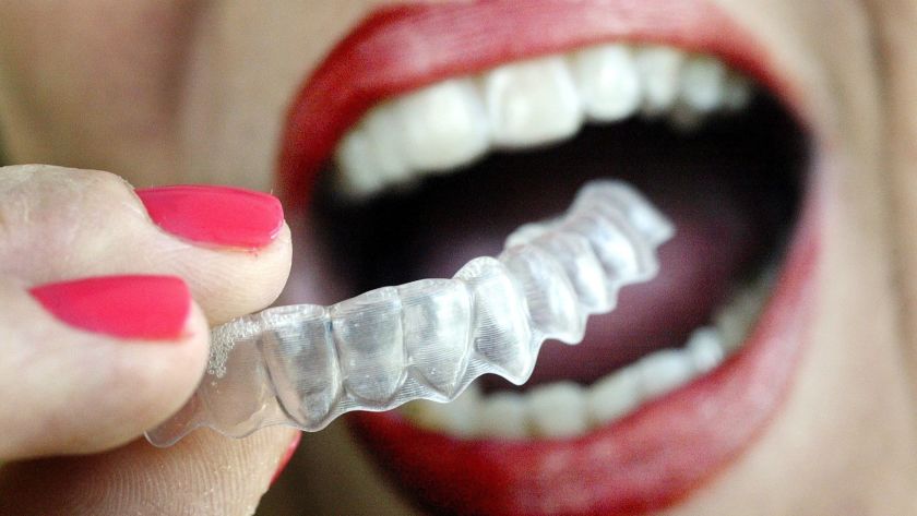 Invisible Braces: Types, How They Work & Cost (Want a Straight Smile?)