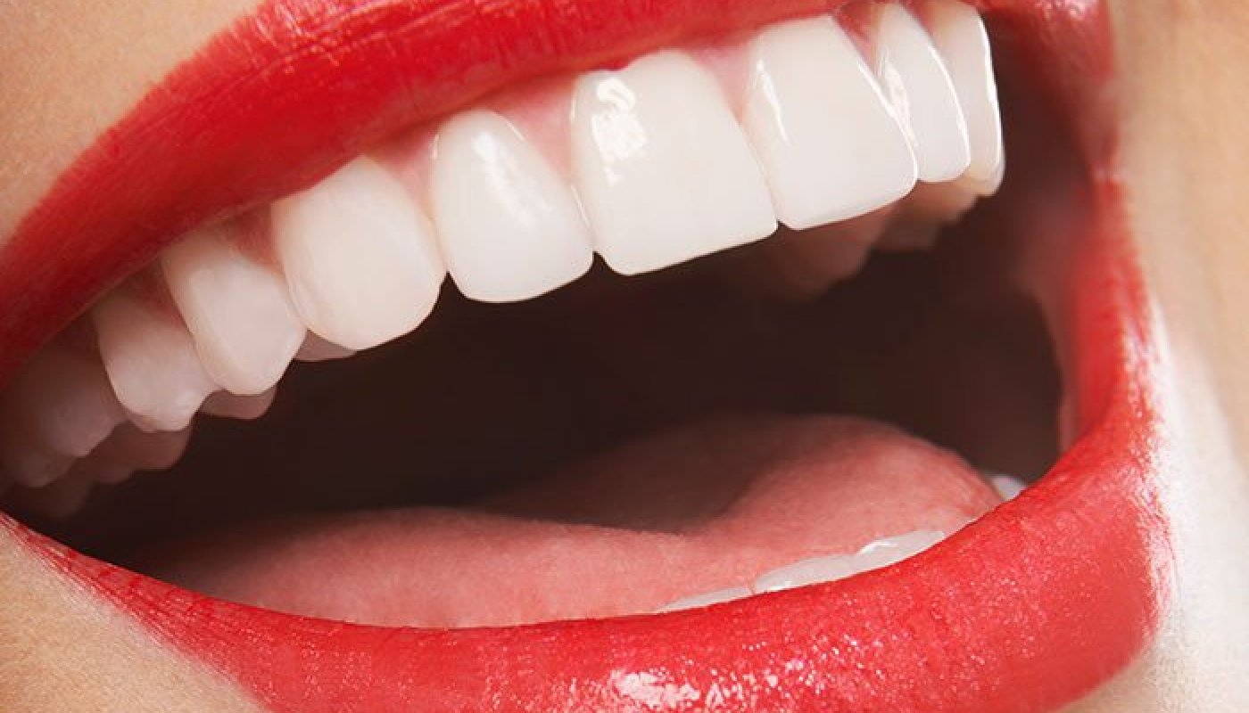 porcelain-veneers