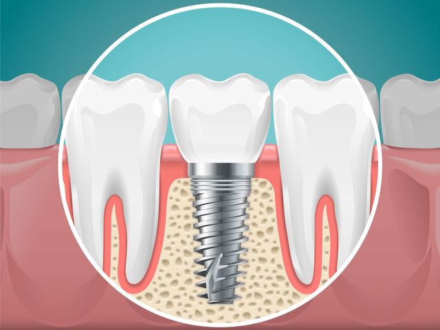 dental-implant-candidate