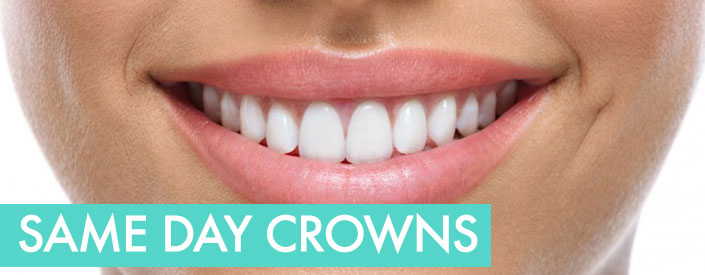 Don't Wait! Repair Damaged Teeth With CEREC Same-Day Dental Crowns