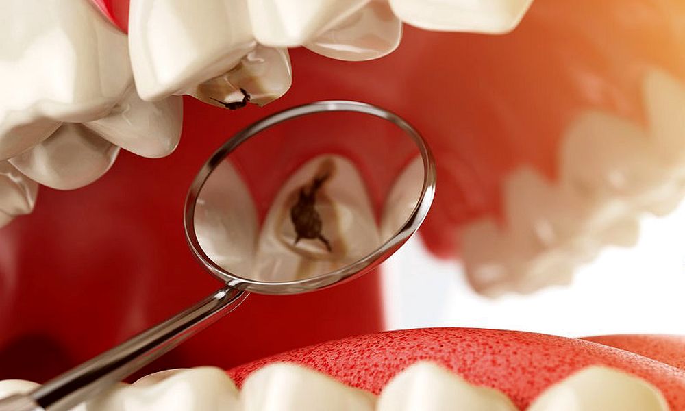tooth-decay-treatments