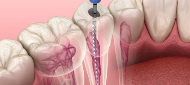 Root Canal Solution: Restore Your Tooth with a Root Canal & Crown